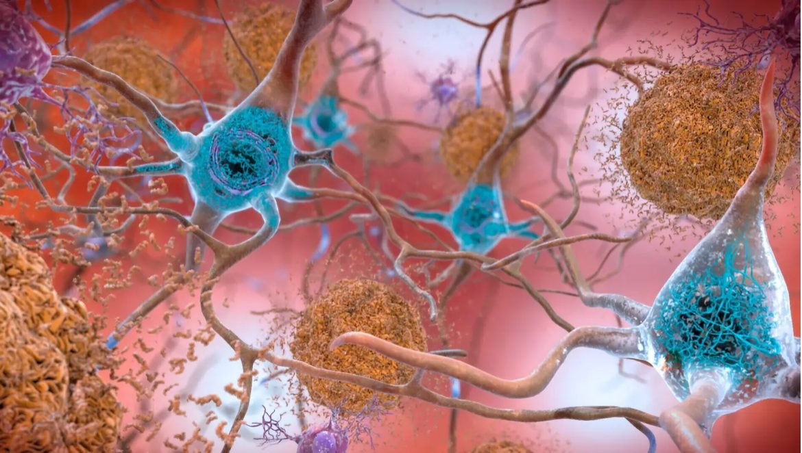 Ilustração educativa de neurônios e placas de beta-amiloide na doença de Alzheimer (NIA/NIH)